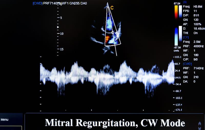 new-port-richey-mitral-heart-valve-regurgitation.jpg