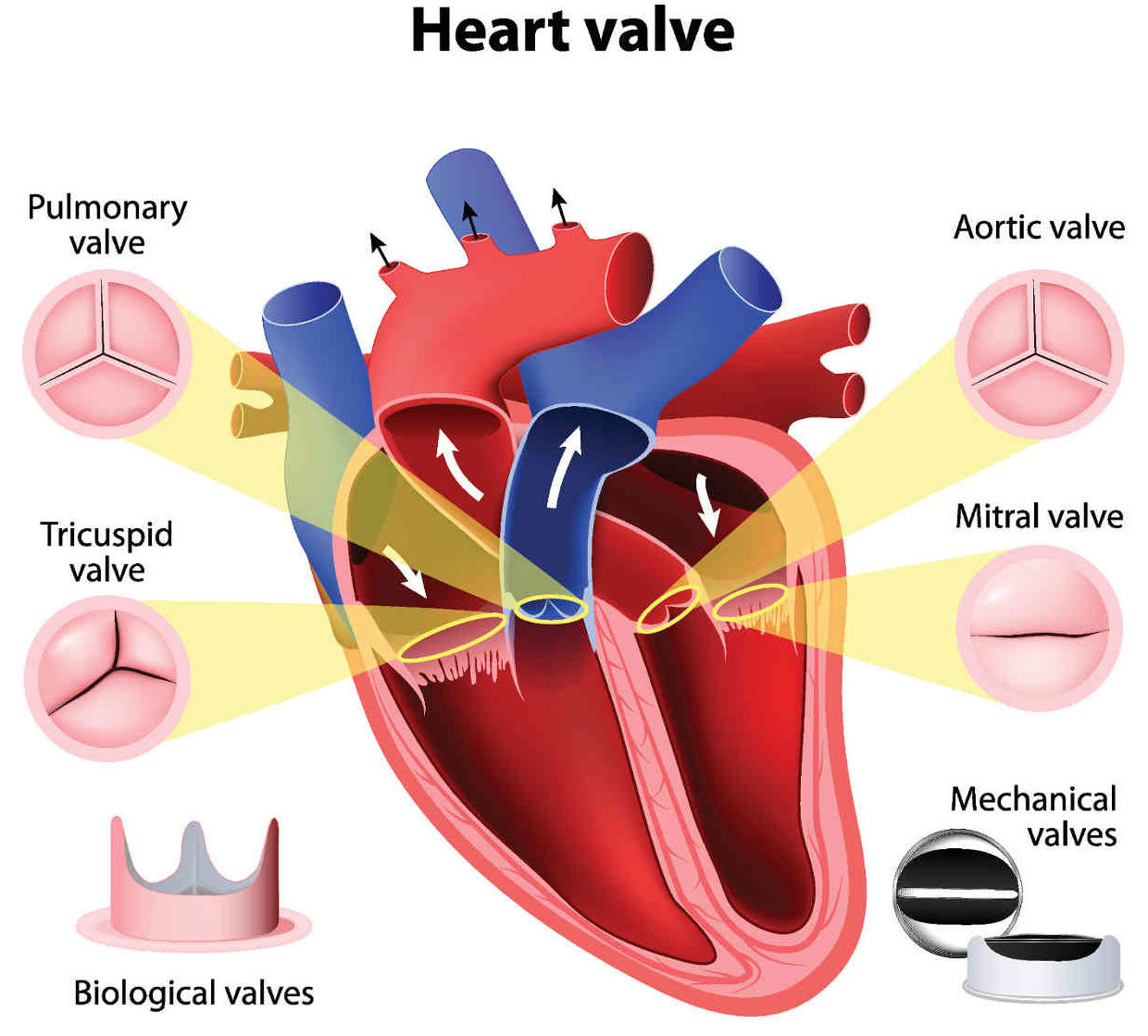 mitral valve disease