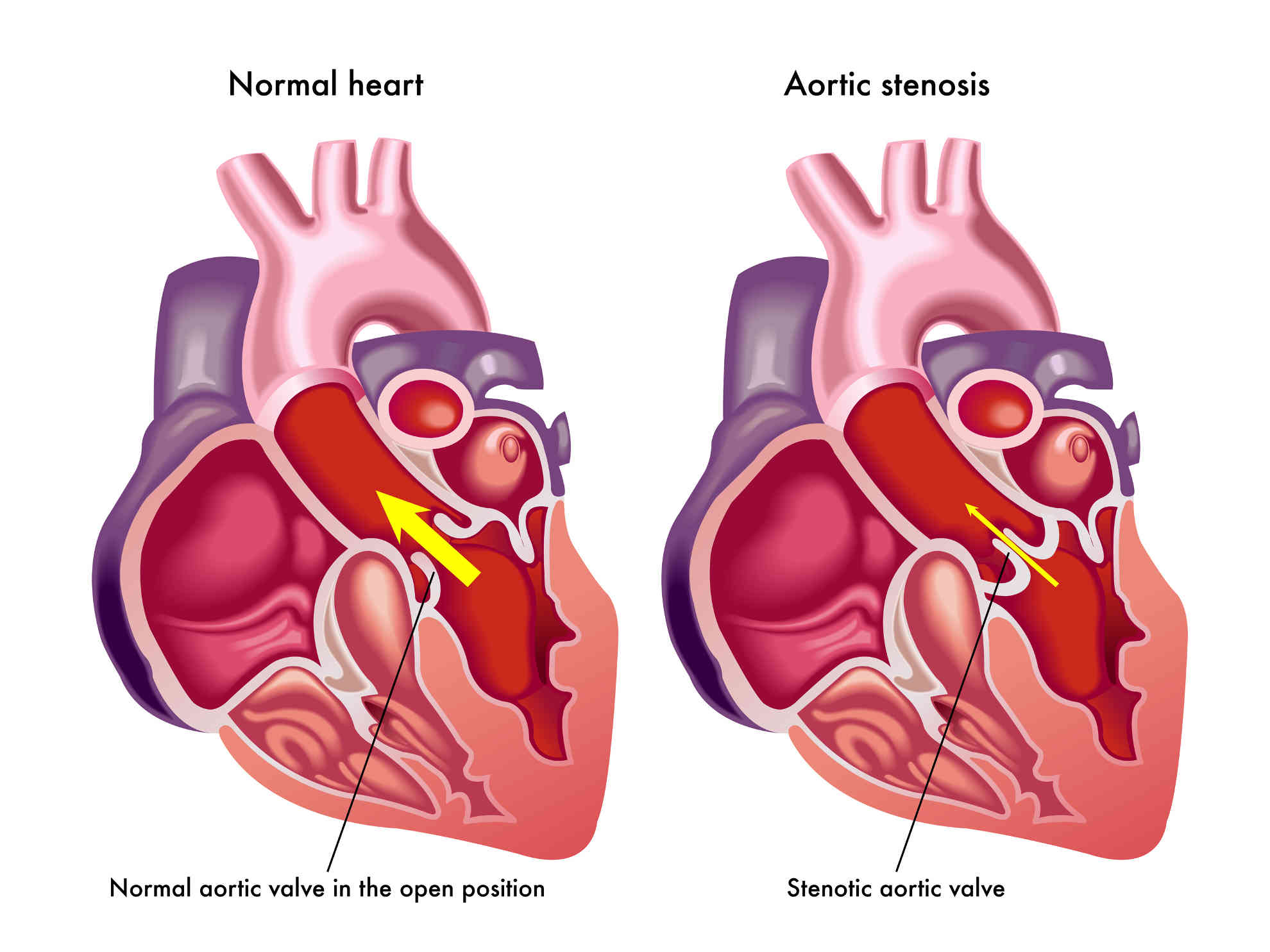 What Is A Calcified Heart Valve Dr Peter Mikhail