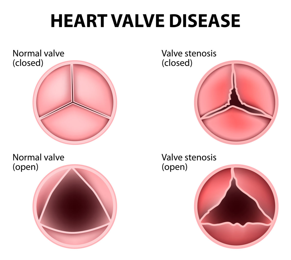 bigstock-Heart-Valve-Disease-113282243-1200x1071.jpg